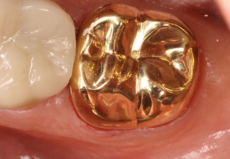 کاربردهای فلز طلا در دندانپزشکی