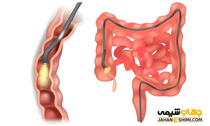 آندوسکوپی چیست و چه کاربردهایی دارد؟