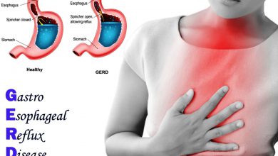 بیماری رفلاکس معده چیست و چه علائم و عوارضی دارد؟