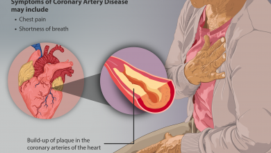 بیماری عروق کرونر چیست و چه علائم و عوارضی دارد؟
