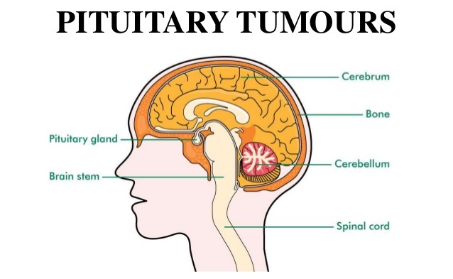 تومورهای هیپوفیز