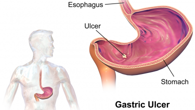 زخم معده چیست و چگونه می توان از آن پیشگیری کرد؟