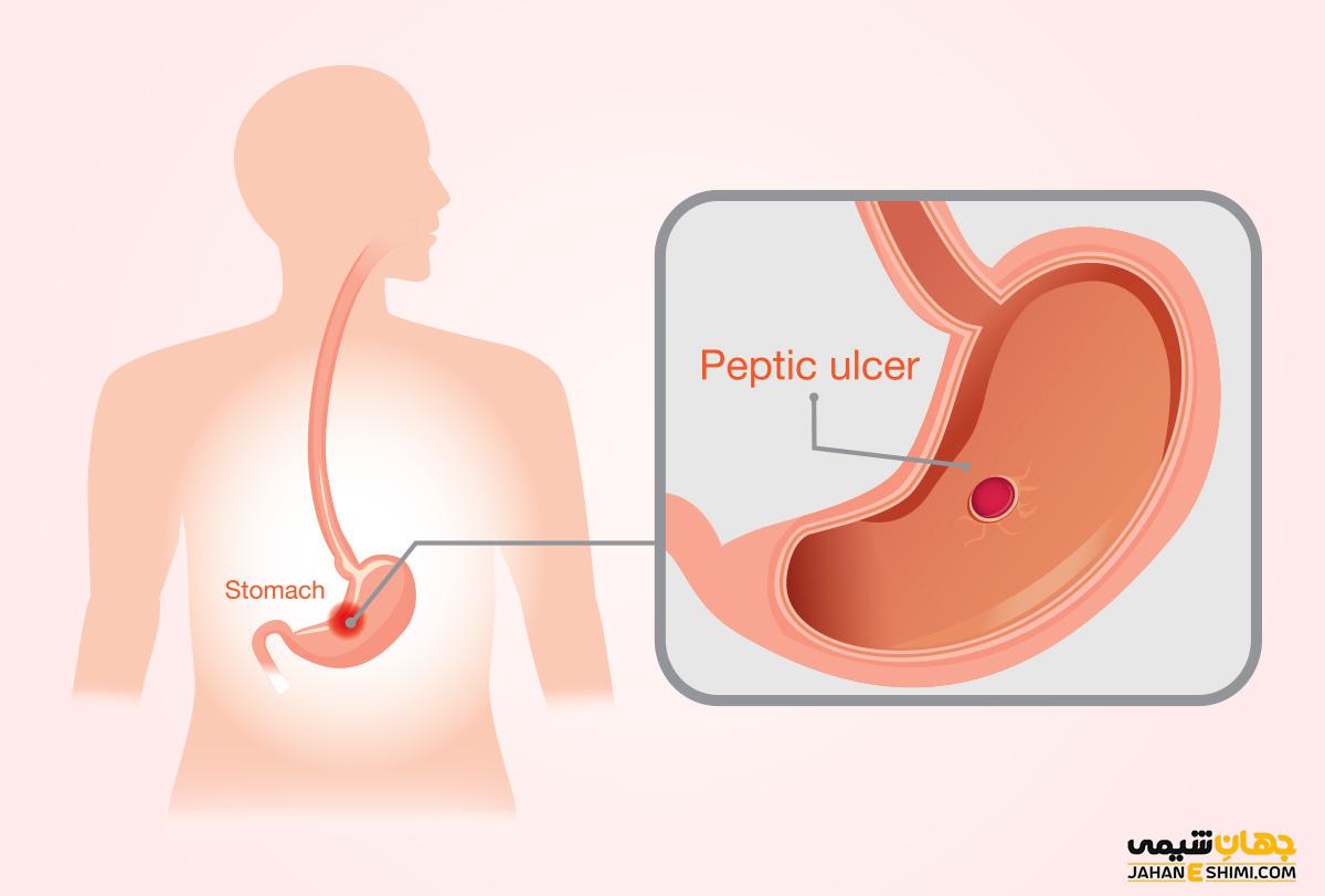 زخم معده چیست و چگونه می توان از آن پیشگیری کرد؟