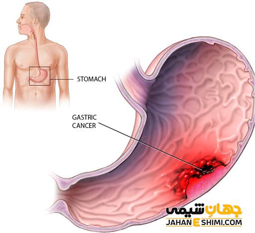 سرطان معده چیست و چه علائمی دارد؟