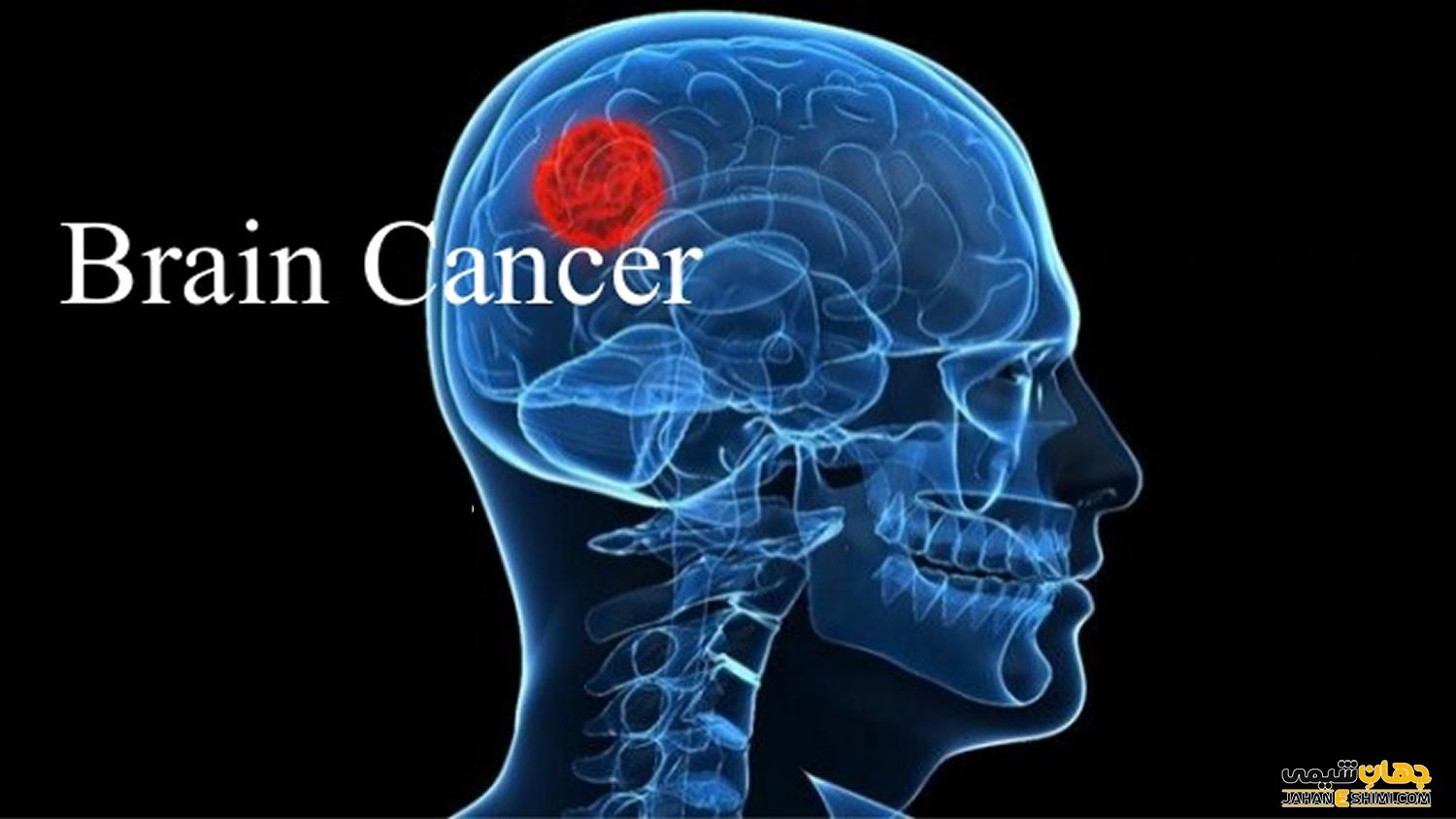 سرطان مغز یا تومور مغزی چیست و چگونه درمان می شود؟