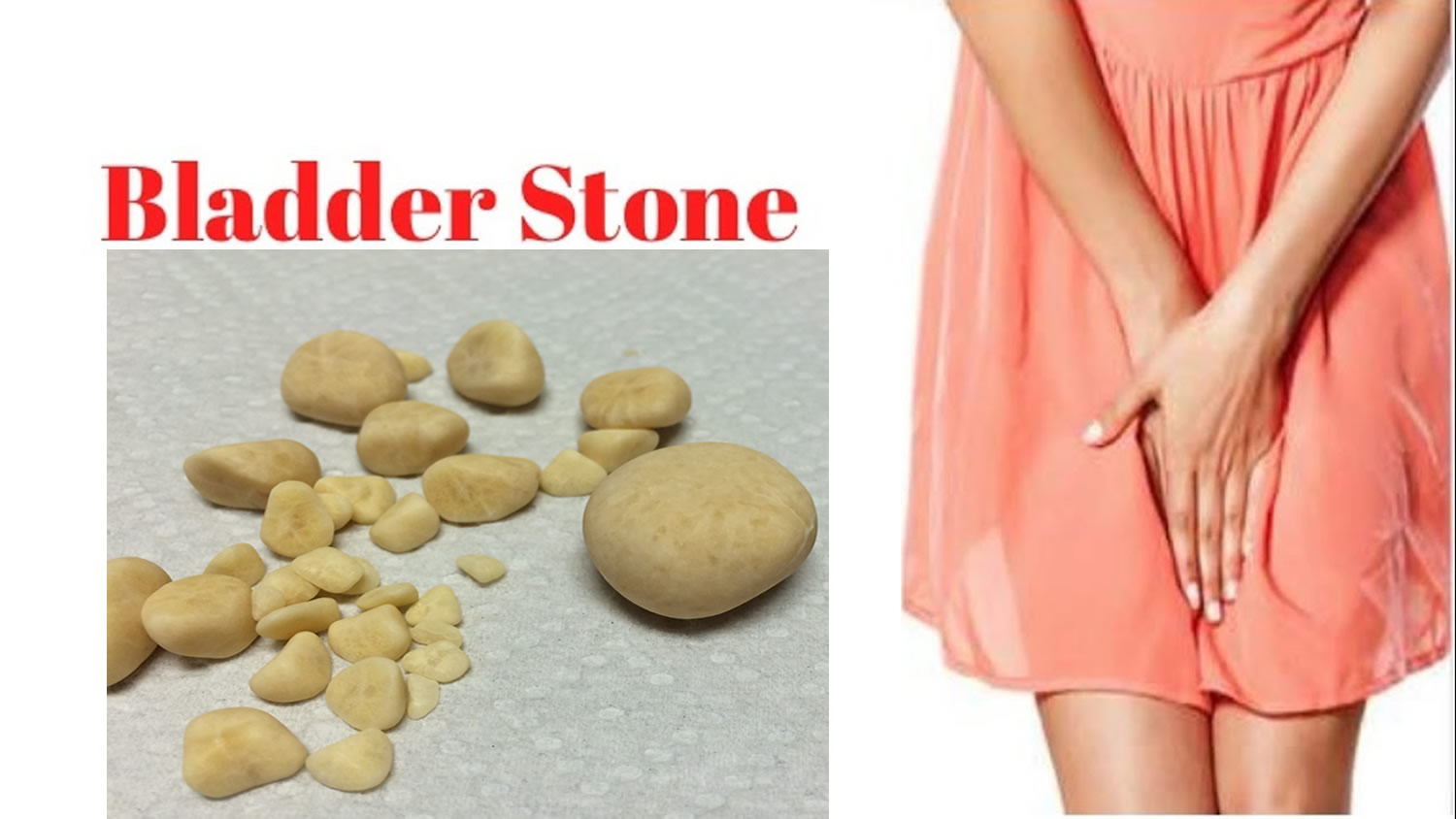 سنگ مثانه چیست و چه علائم و عوارضی دارد؟