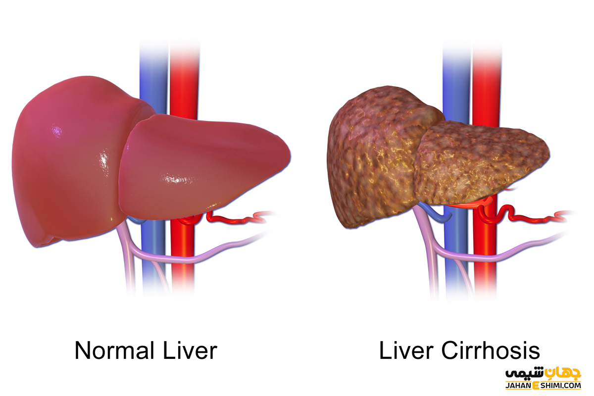 سیروز کبدی چیست و چگونه می توان از آن پیشگیری کرد؟