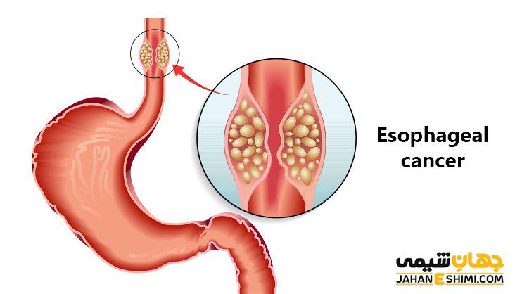 علائم و عوارض سرطان مری چیست و آیا قابل پیشگیری است؟