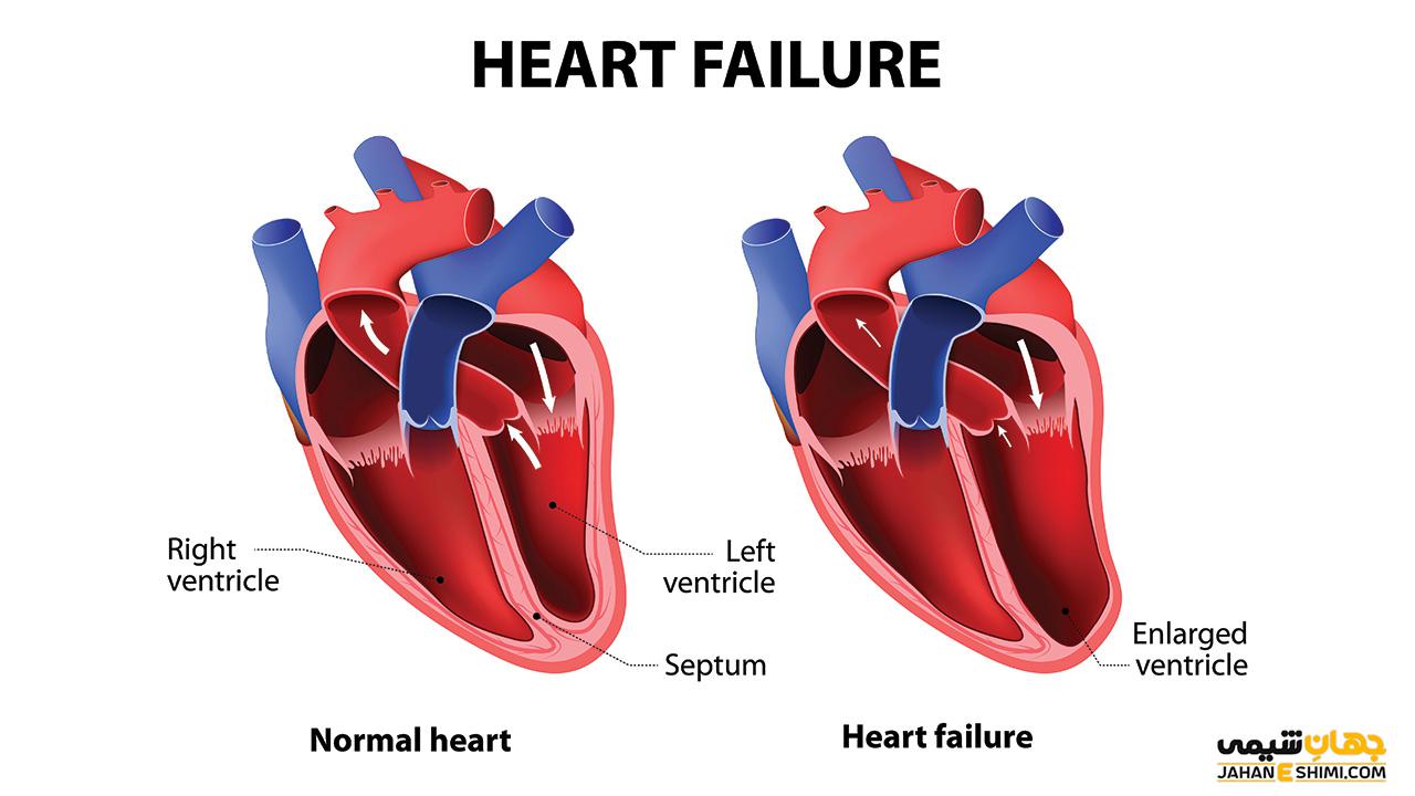 نارسایی قلبی چیست و خطر مرگ ناشی از آن چقدر است؟