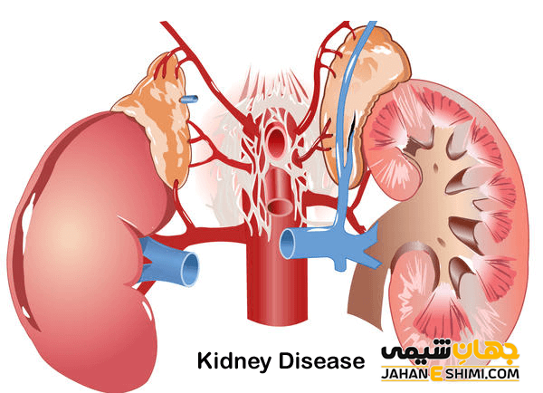 نارسایی کلیه چیست و چگونه عوارض آن زندگی را تهدید می کند؟
