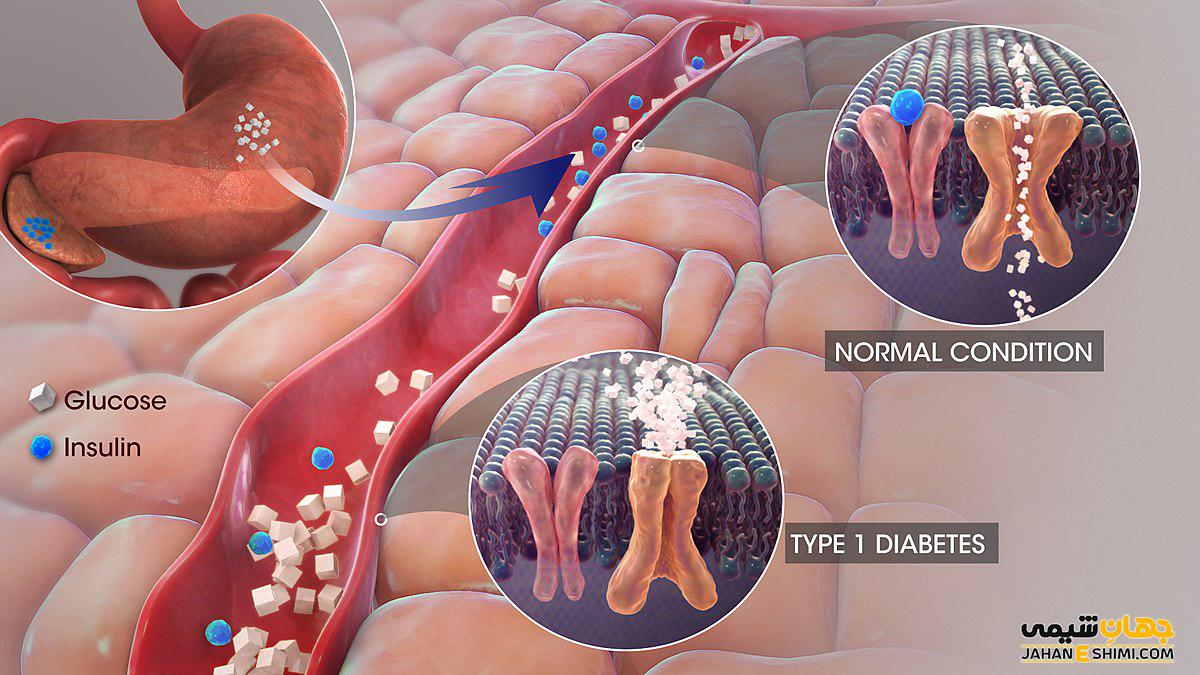 یبماری دیابت نوع 1 چیست و ریسک فاکتورهای آن کدامند؟