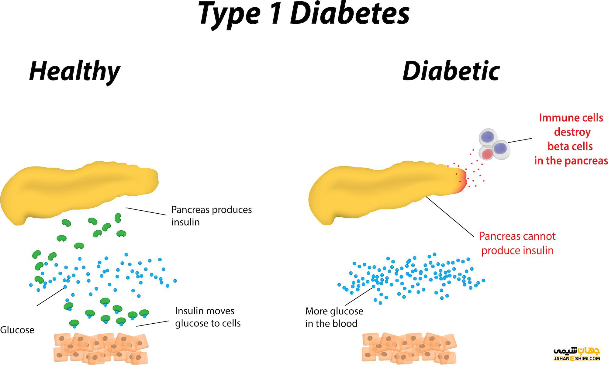 یبماری دیابت نوع 1 چیست و ریسک فاکتورهای آن کدامند؟