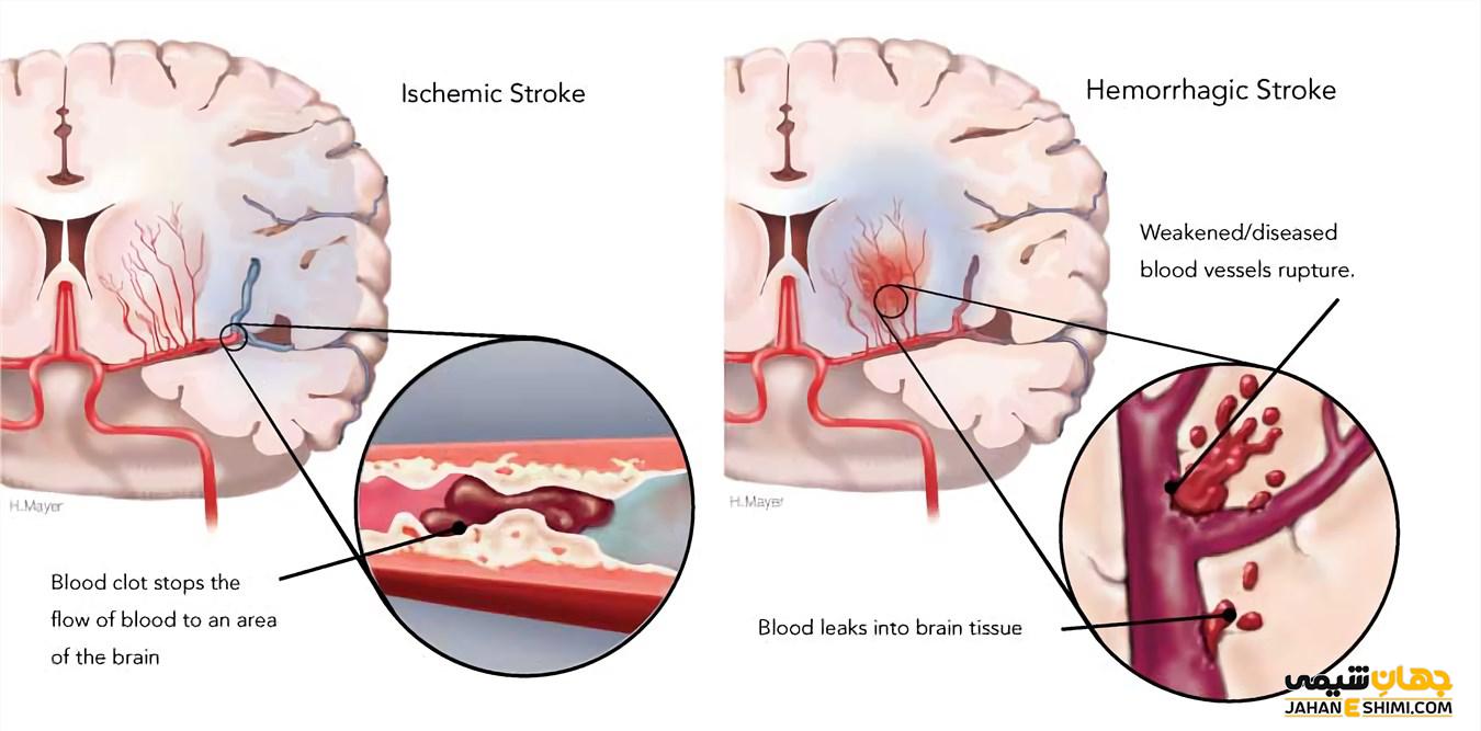 Что такое ишемический инсульт головного мозга
