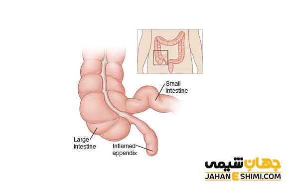 آپاندیس و آپاندیسیت