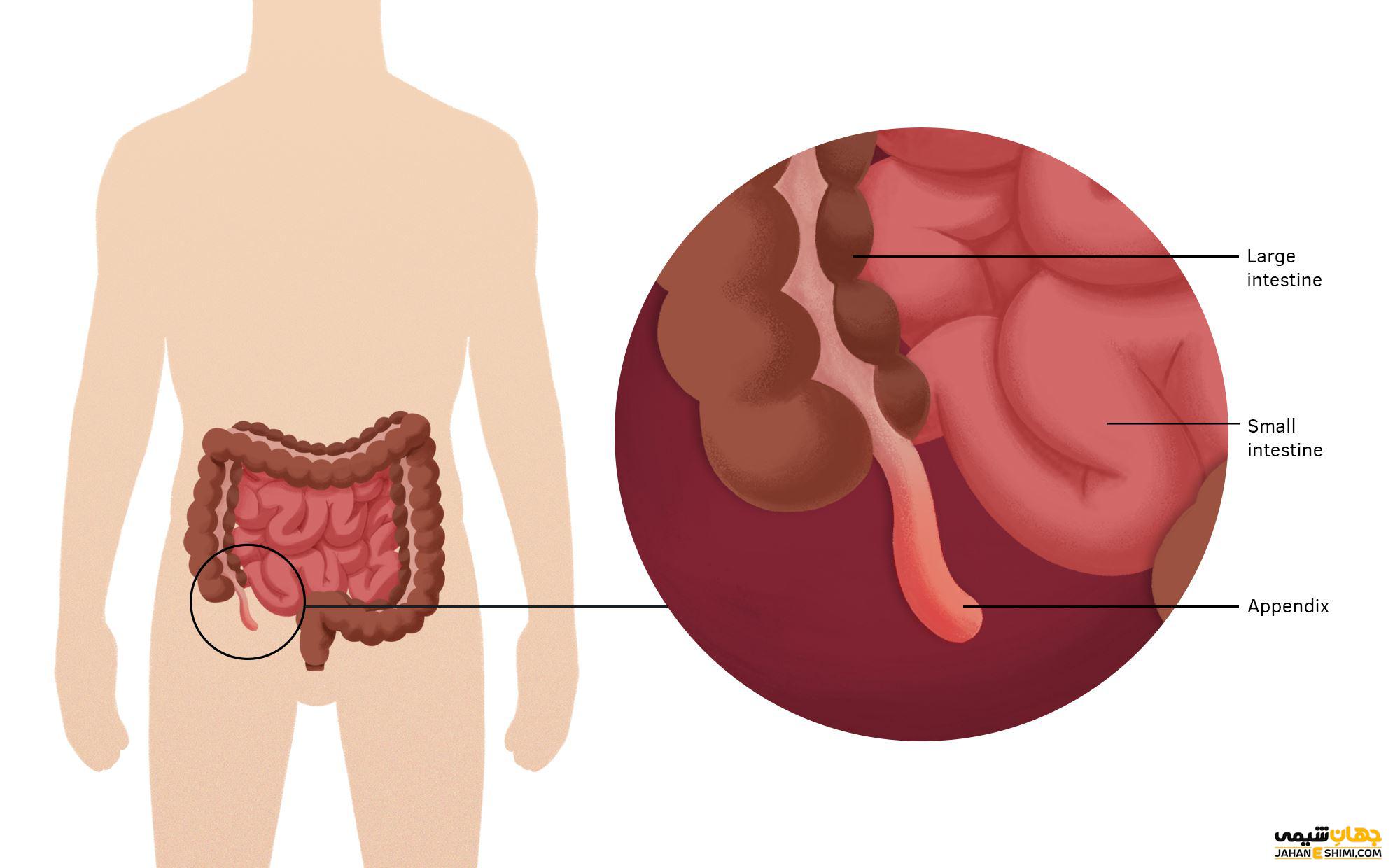 آپاندیسیت چیست و عوارض خطرناک آن کدامند؟