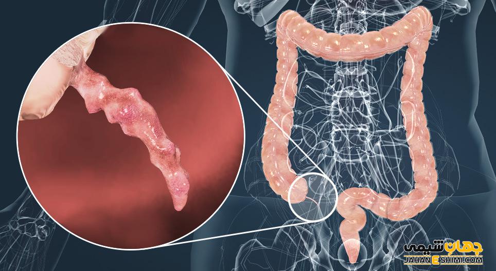 آپاندیسیت چیست و عوارض خطرناک آن کدامند؟