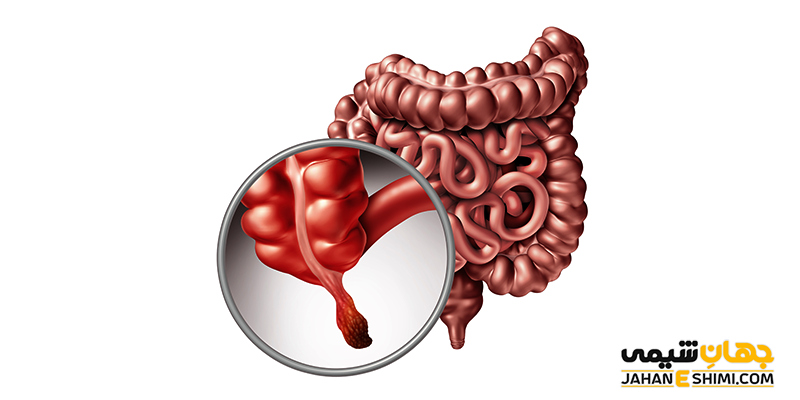 آپاندیسیت چیست و عوارض خطرناک آن کدامند؟