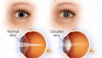 بیماری آب مروارید چیست و چگونه می توان از آن پیشگیری کرد؟