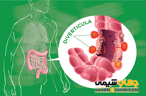 بیماری دیورتیکولیت چیست و چگونه درمان می شود؟