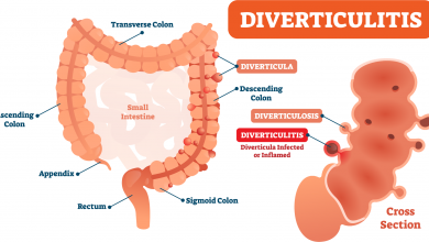 بیماری دیورتیکولیت چیست و چگونه درمان می شود؟