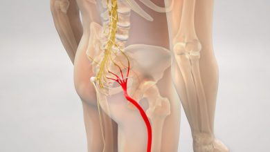 بیماری سیاتیک چیست و چه علائم و عوارضی دارد؟