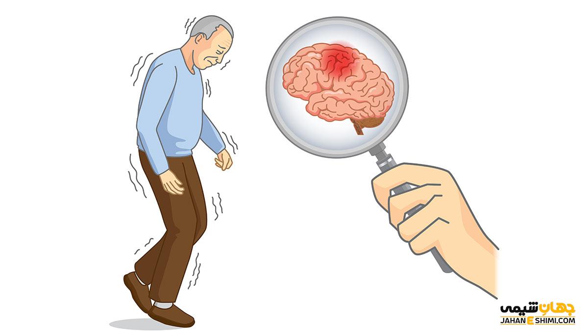 بیماری پارکینسون چیست و چگونه می توان از آن پیشگیری کرد؟