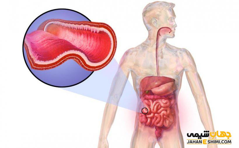 بیماری کرون چیست و از علائم و عوارضی دارد؟