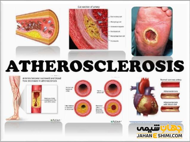 تصلب شرایین یا آترواسکلروز چیست و چه عواقبی دارد؟