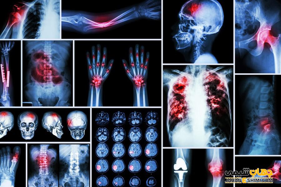سرطان استخوان چیست و چه علائم و عوارضی دارد؟
