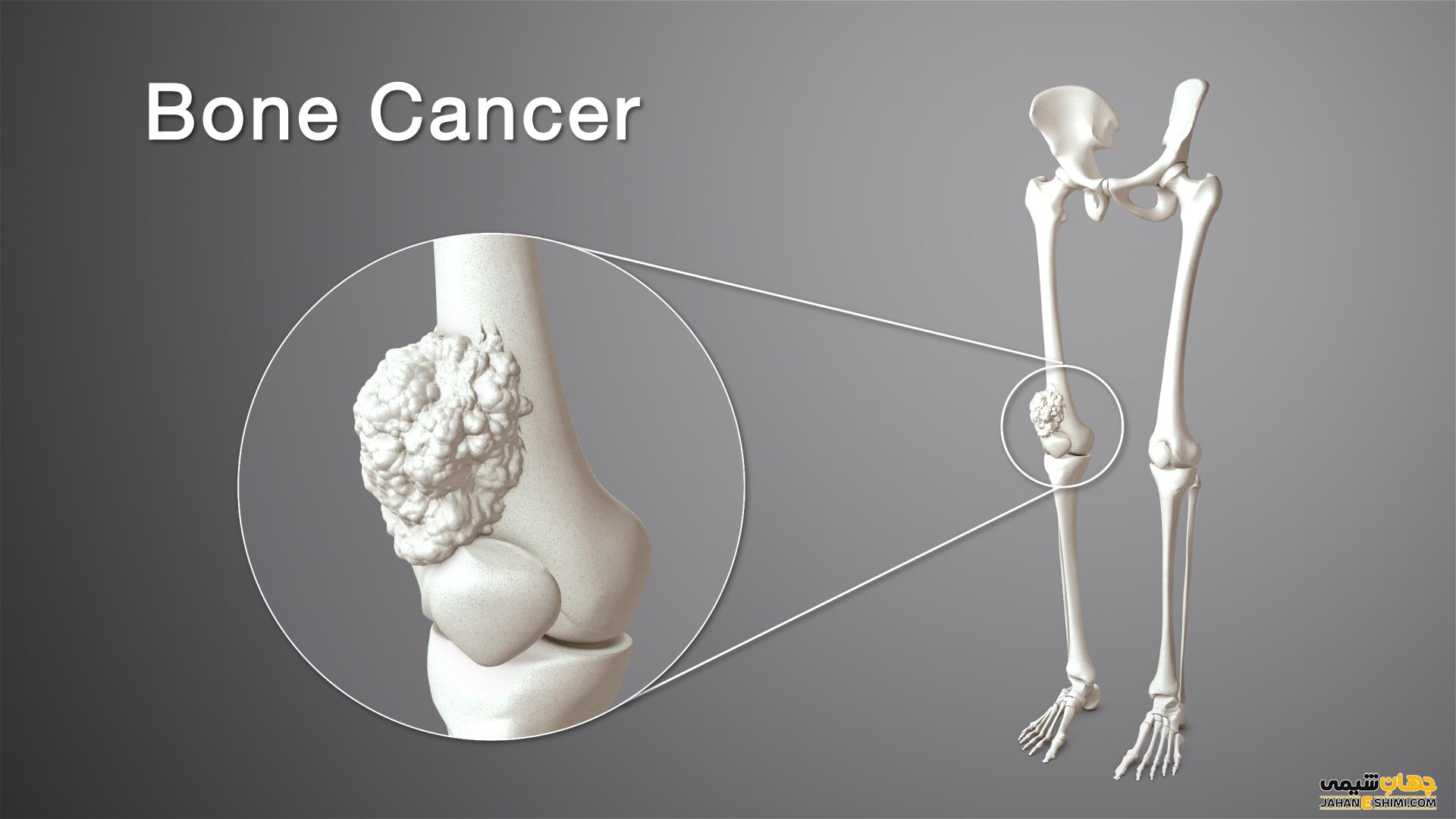 سرطان استخوان چیست و چه علائم و عوارضی دارد؟