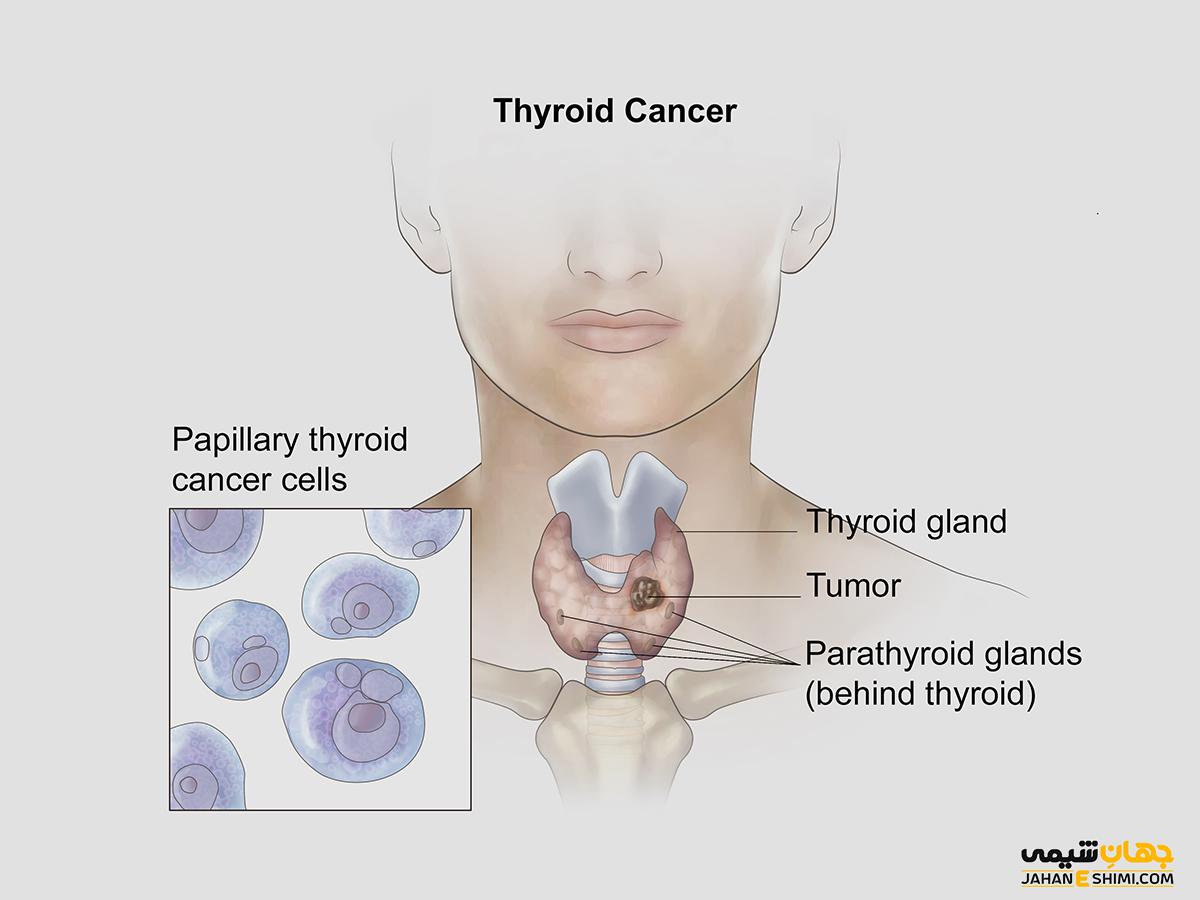 سرطان تیروئید چیست و چه علائمی و عوارضی دارد؟
