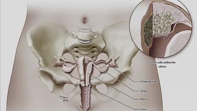 سرطان رحم چیست و چرا به آن مبتلا می شویم؟