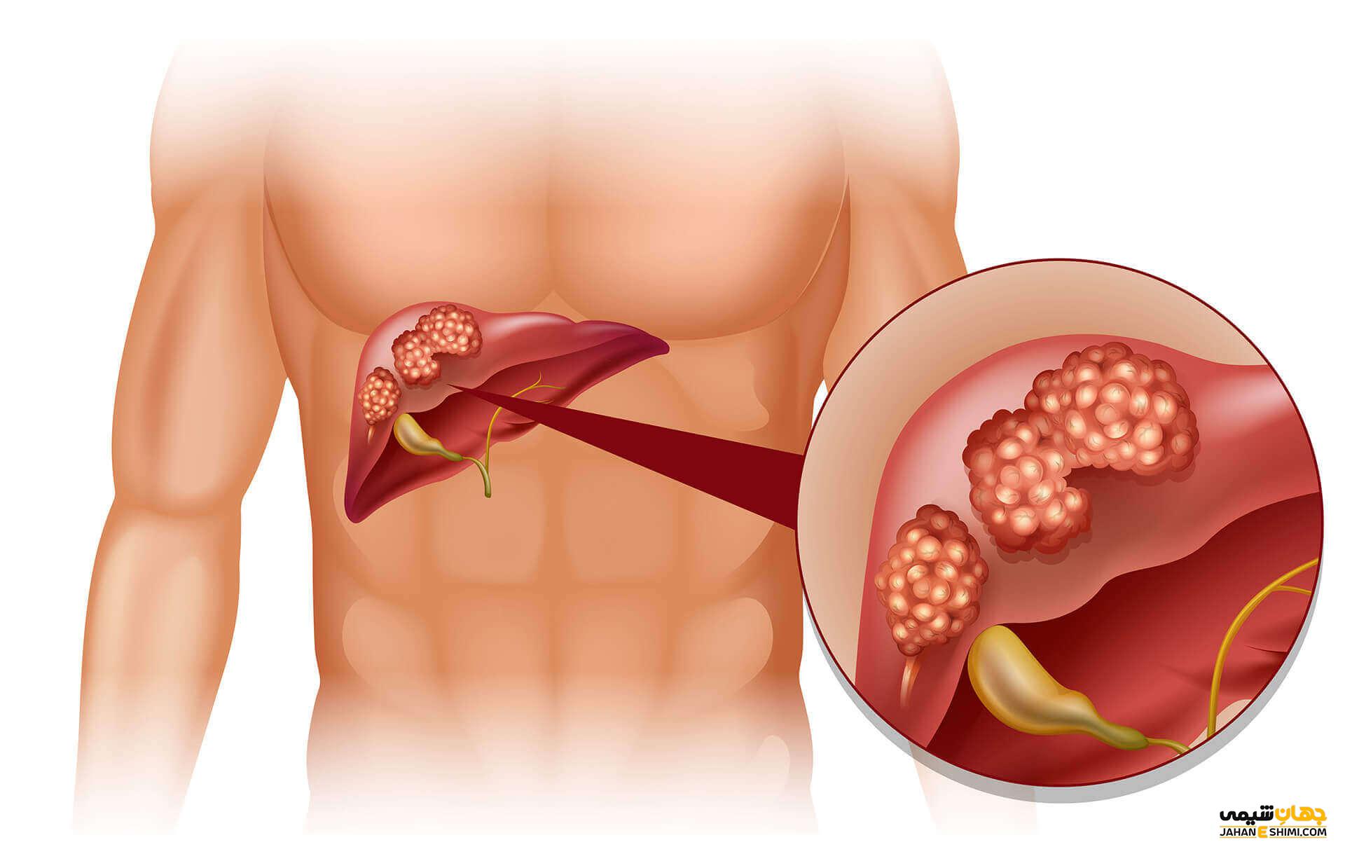 سرطان کبد چیست و چرا به سرطان کبد مبتلا می شویم؟
