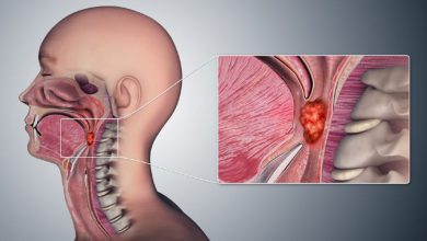 سرطان گلو چیست و چه علائم و عوارضی دارد؟