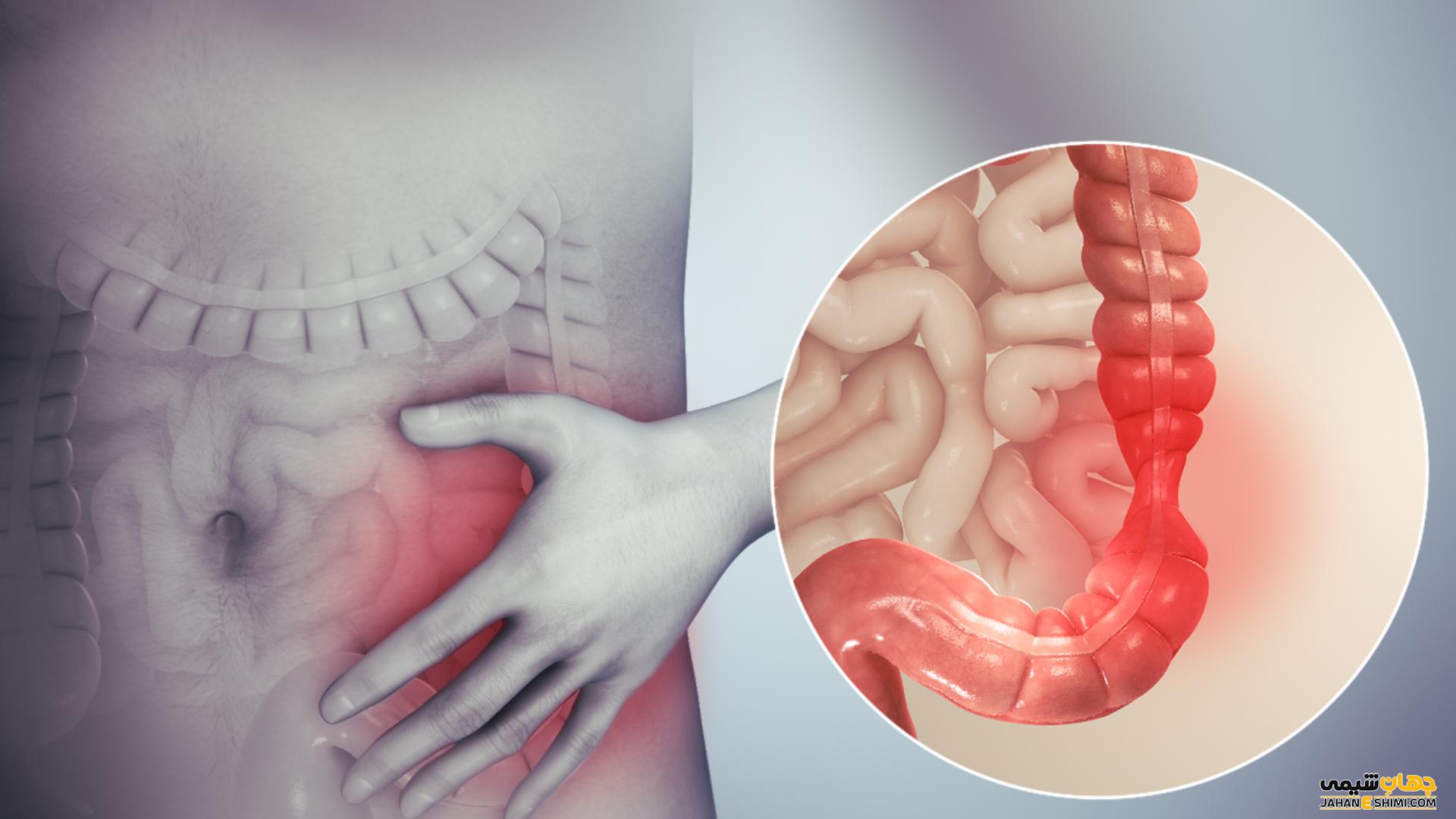 سندرم روده تحریک پذیر چیست و چه علائمی دارد؟