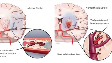 سکته مغزی چیست و چرا دچار سکته مغزی می شویم؟
