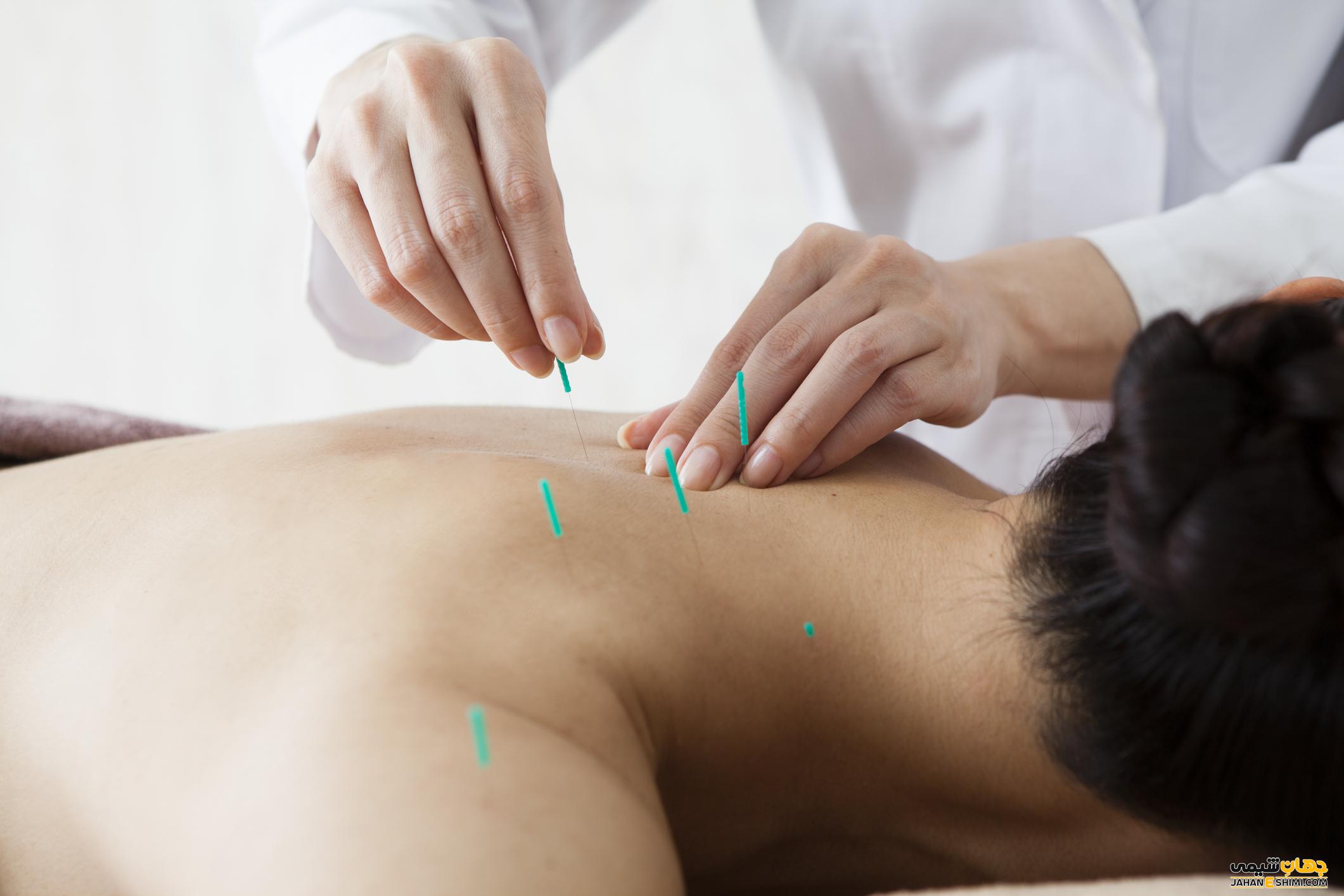 طب سوزنی چیست و از اثرات درمانی آن چه می دانید؟