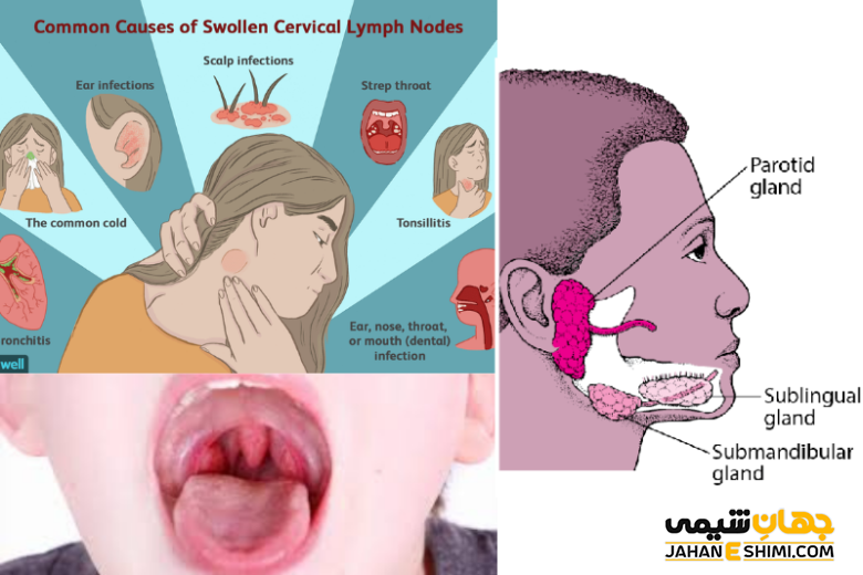 عوامل هشداردهنده لنفوم