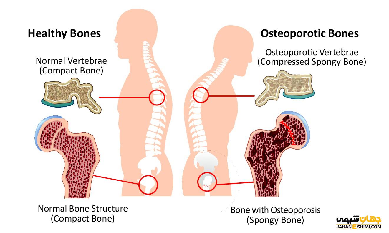 پوکی استخوان چیست و چرا به آن مبتلا می شویم؟