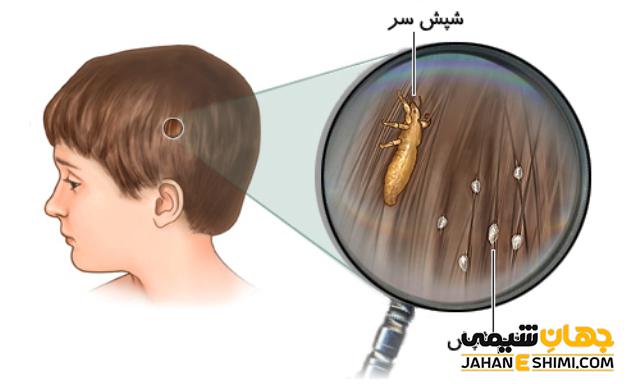 سم شپش چیست و چه کاربردهایی دارد؟