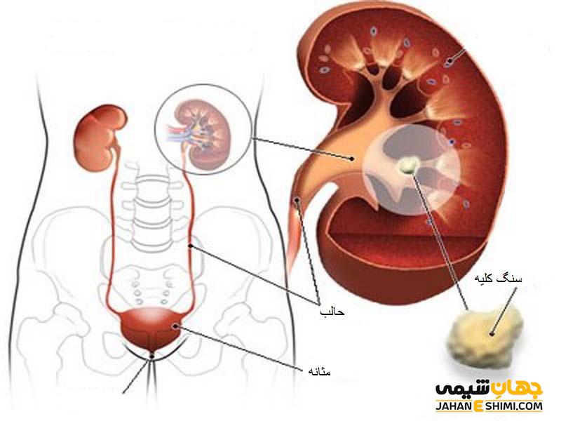 فواید و مضرات عرقیات مناسب تقویت کلیه و سنگ کلیه