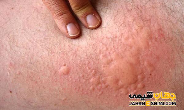 کمک فراوانی به رفع حساسیت و کهیر می کند