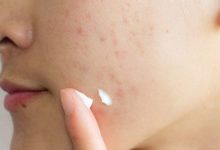 استفاده از کرم برای از بین بردن جای جوش