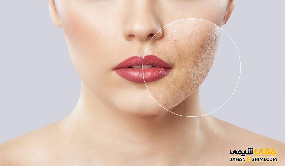بهترین پمادها برای از بین بردن جای جوش و اسکار