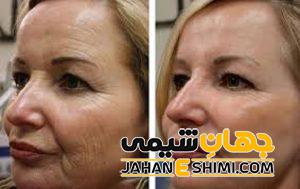 دستگاه لیزر هایفو چیست؟