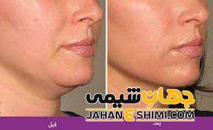 لیفتینگ صورت توسط لیزر هایفو انجام می شود.
