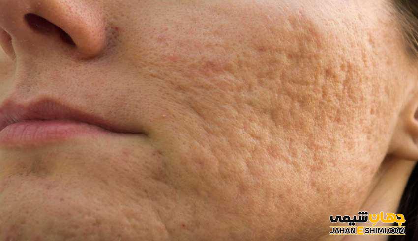 استفاده از کرم برای از بین بردن جای جوش
