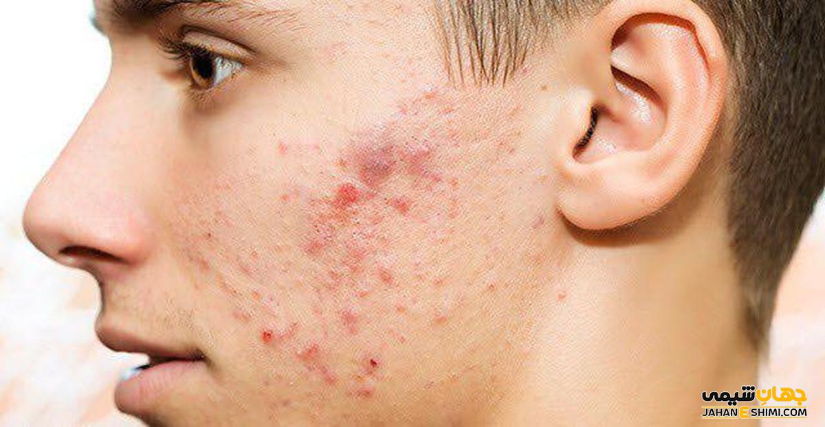 مشکلات پوستی را برطرف می کند