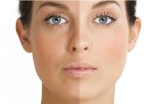 انتخاب بهترین کرم برای رفع کک و مک پوست صورت و بدن