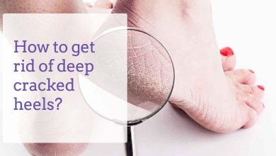 کرم رفع ترک پا مناسب چیست؟